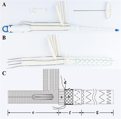 A Novel Sutureless Integrated Stented (SIS) Graft Prosthesis for Type A Aortic Dissection: A Pilot Study for a Prospective, Multicenter Clinical Trial